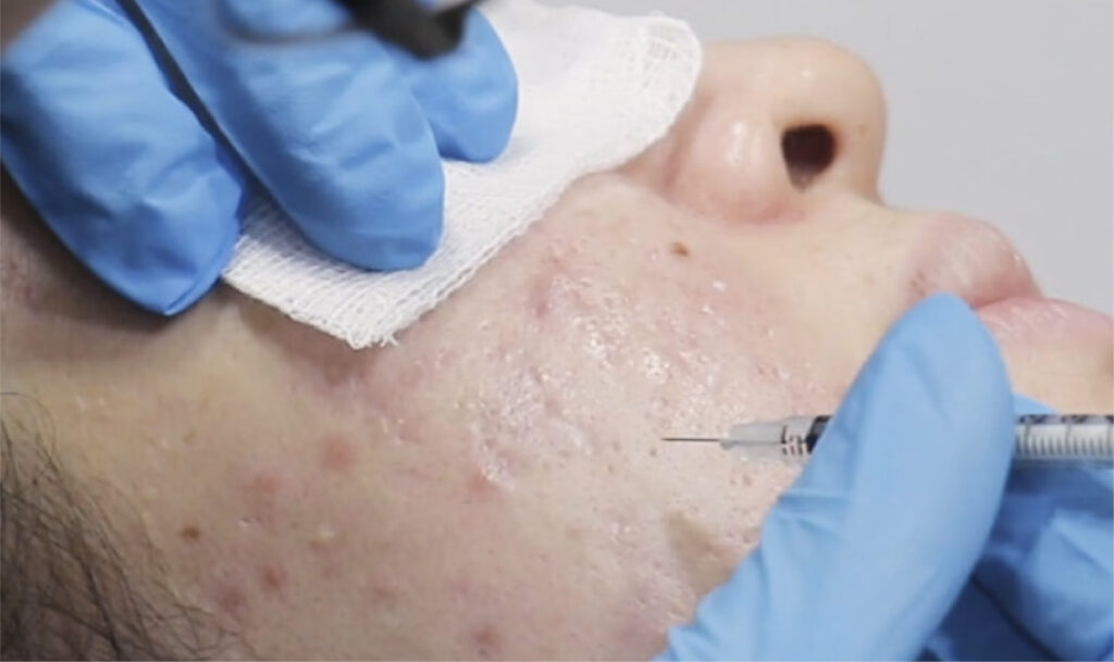 Chemical Reconstruction of Scars Chennai