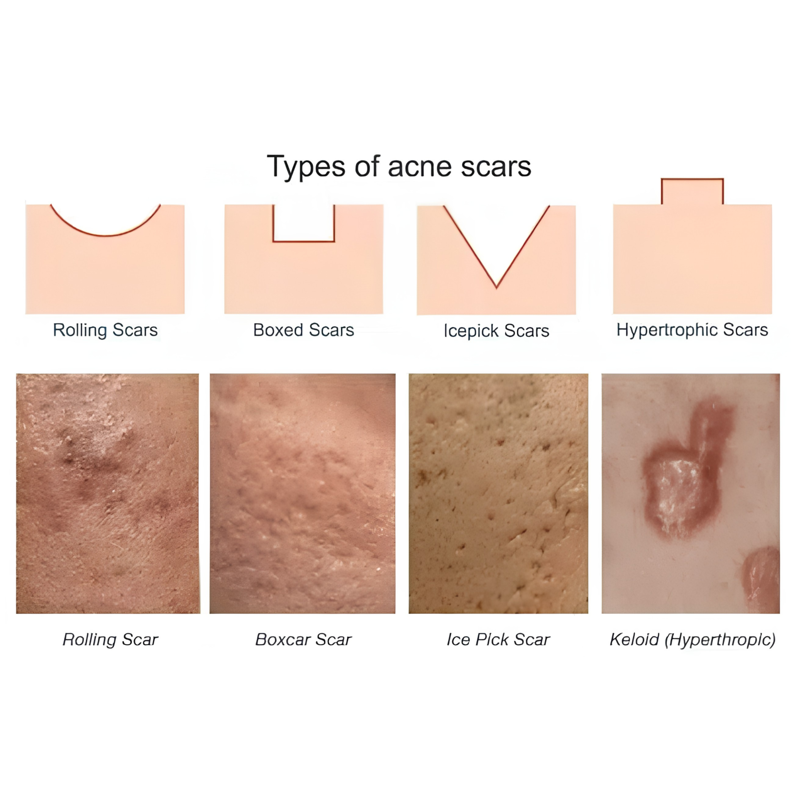 Types of Acne Scars
