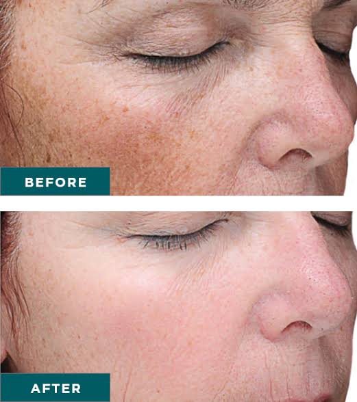 Scar Reviving Peels Chennai