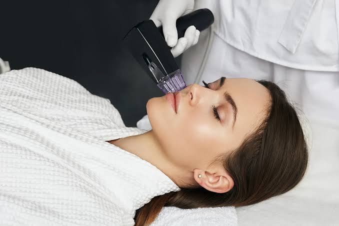 Morpheus8 Acne Scar Treatment Chennai
