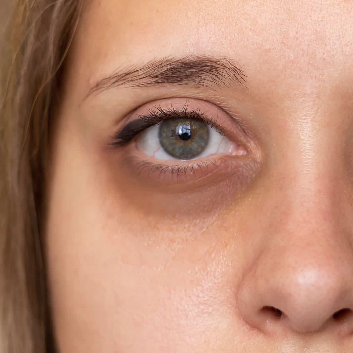 Dark circles around the eyes