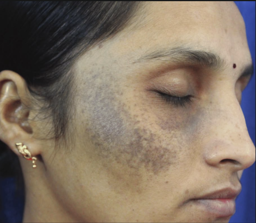 Riehl's melanosis and lichen planus pigmentosus