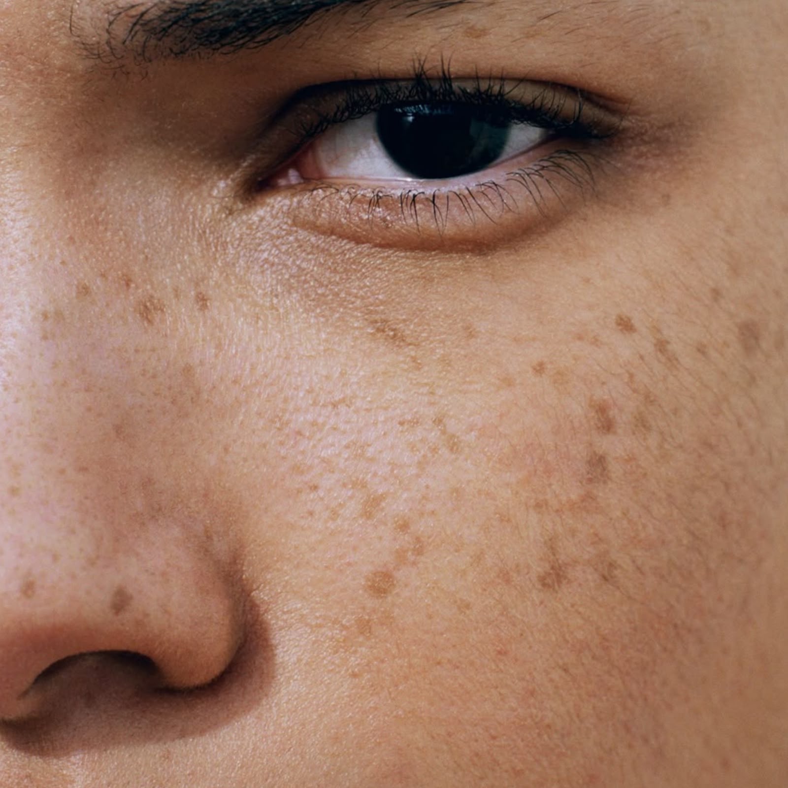 Freckles and solar lentigens on skin