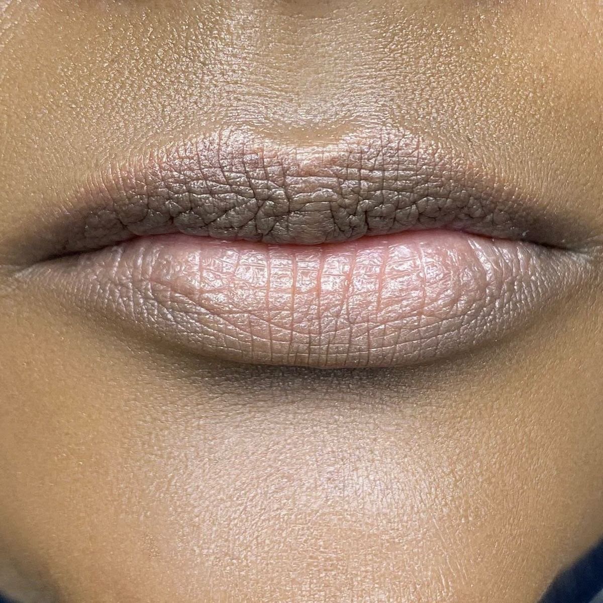 Lip pigmentation darkening