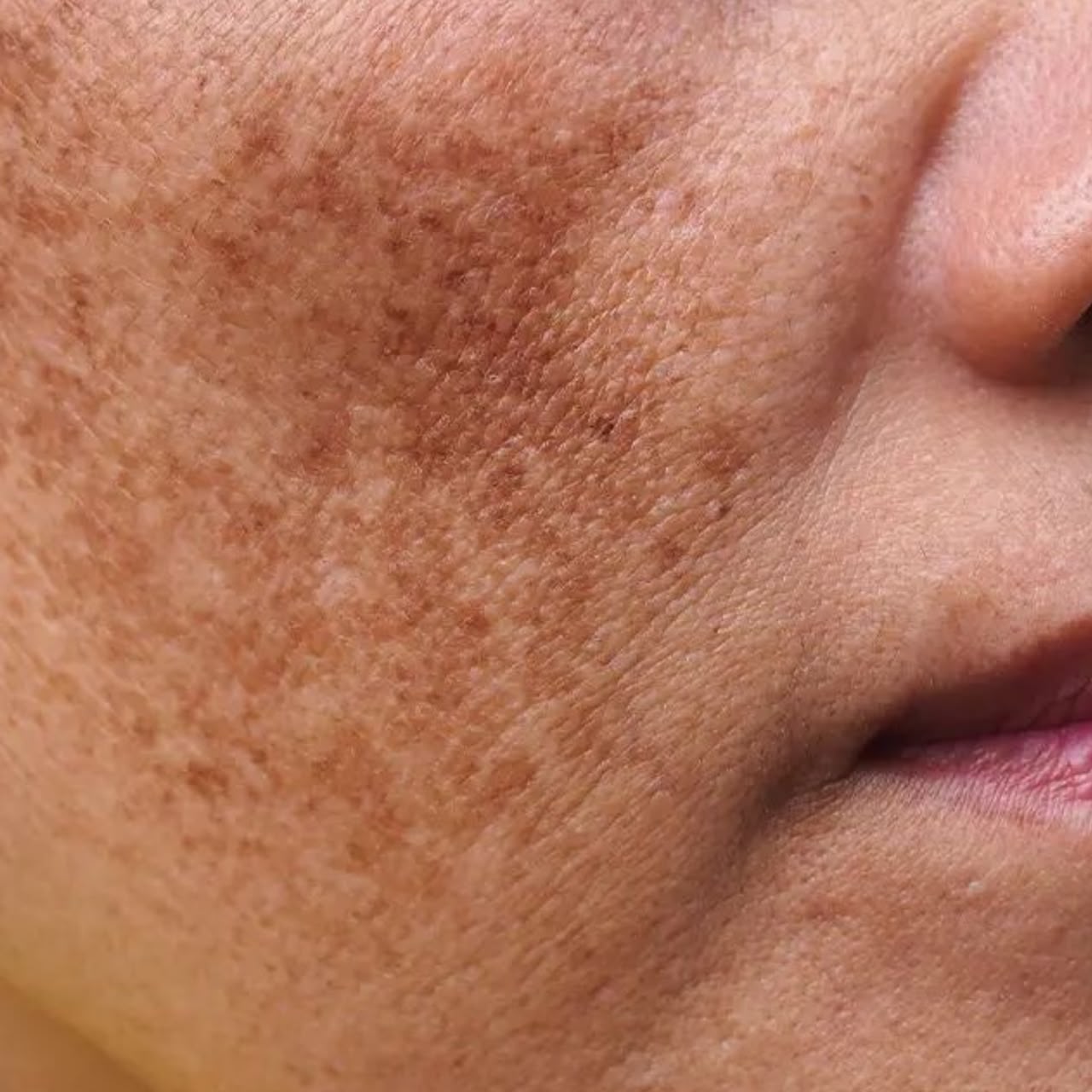 Melasma on cheeks and forehead