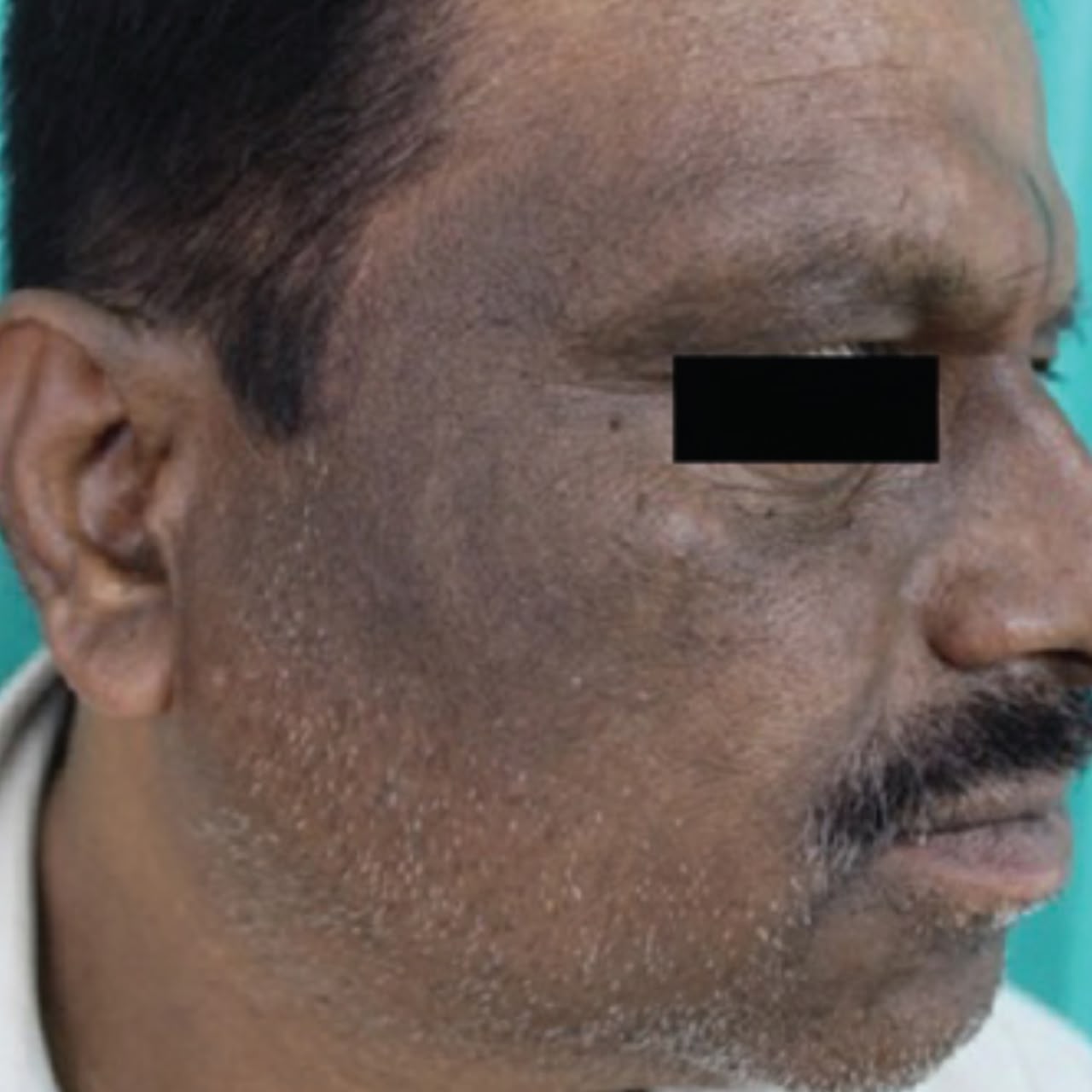 Frictional melanosis dark patches