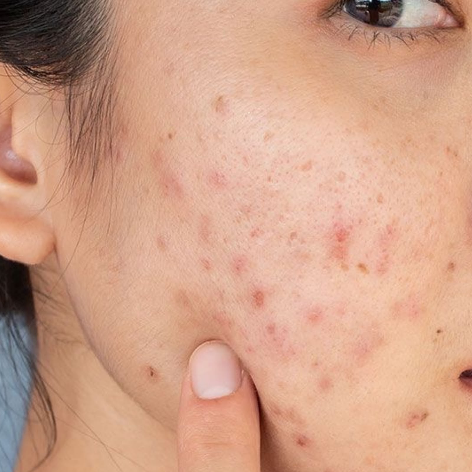 Post-inflammatory hyperpigmentation dark marks