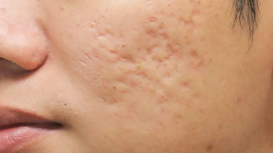Boxcar Scars acne scar example