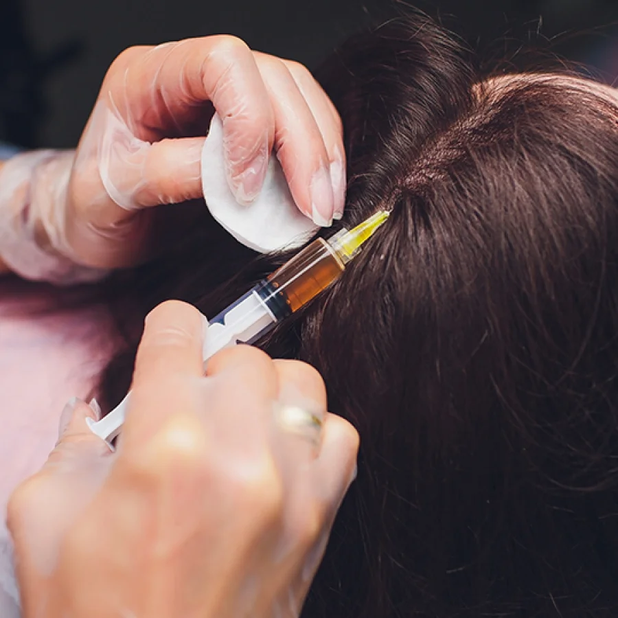 Growth Factor Concentrate (GFC) therapy for hair regrowth