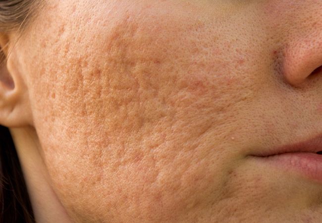 Acne scars and uneven skin texture