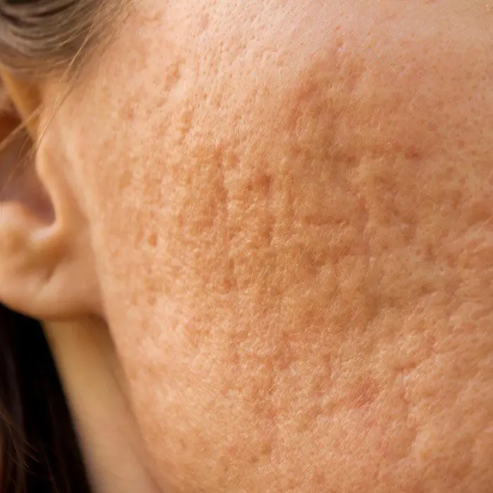 Rolling Scars acne scar example