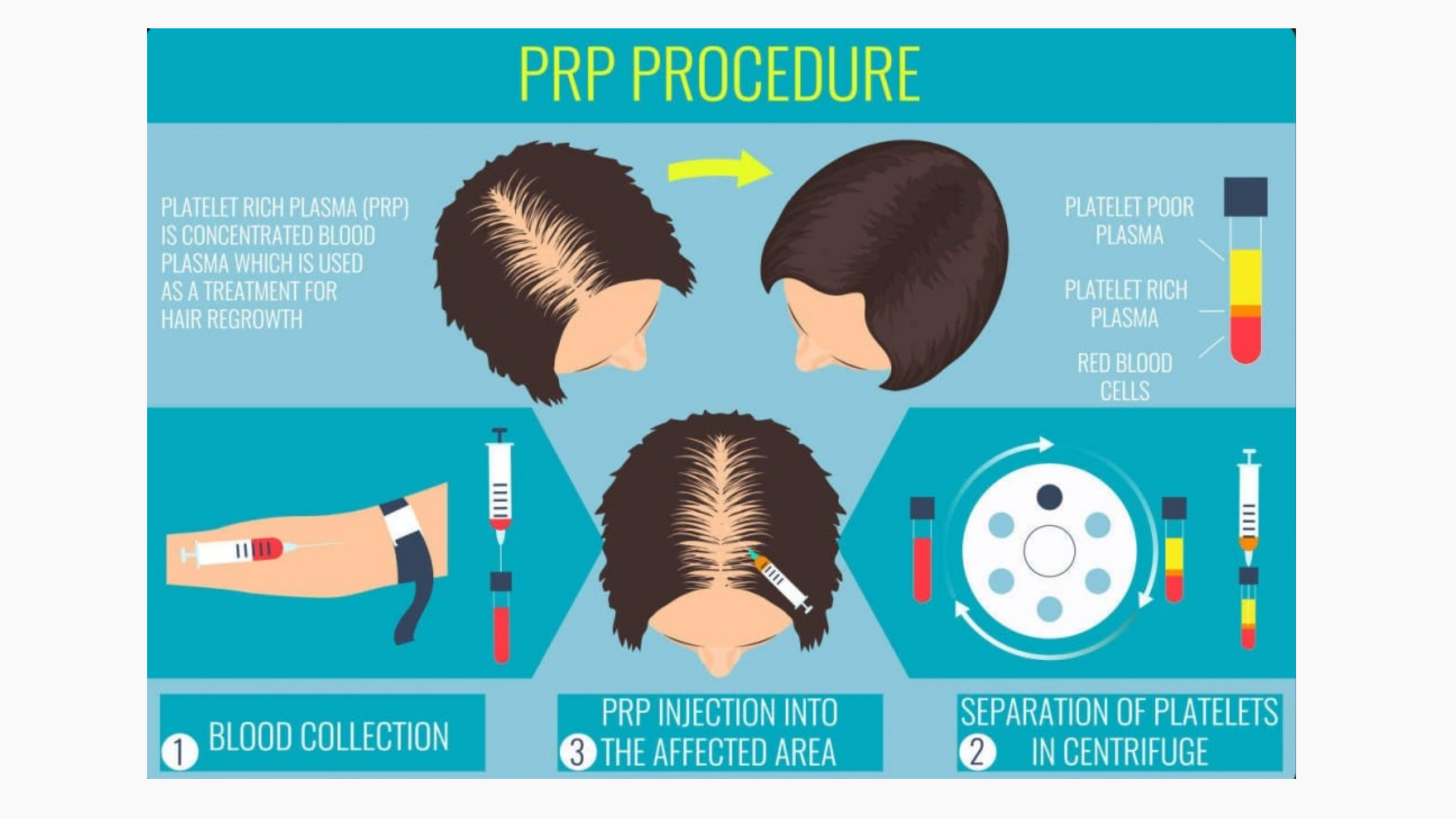 PRP hair treatment procedure at Ojas Health Multispeciality Clinic, Chennai