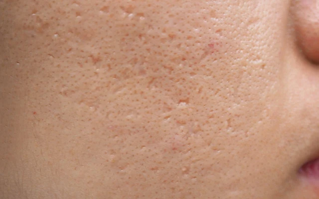 Ice Pick Scars acne scar example