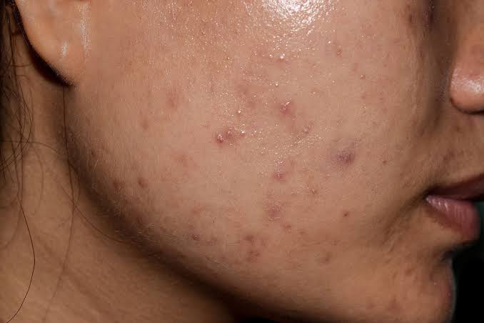 Raised Scars acne scar example