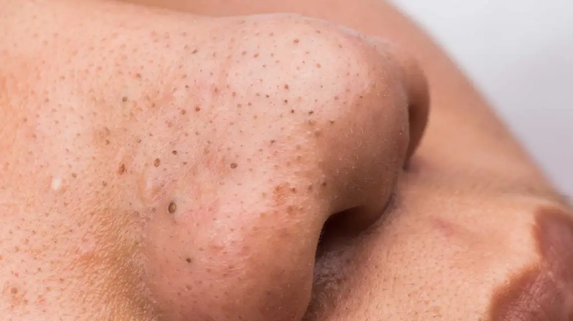Whiteheads and blackheads on the skin