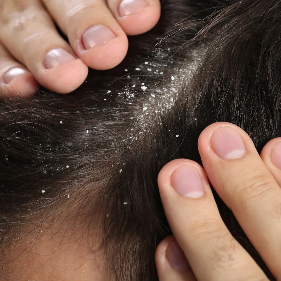 Man with dandruff in dark hair showing scalp flakes and irritation