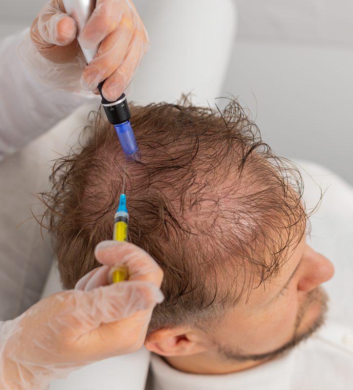 Scalp mesotherapy procedure for hair concerns