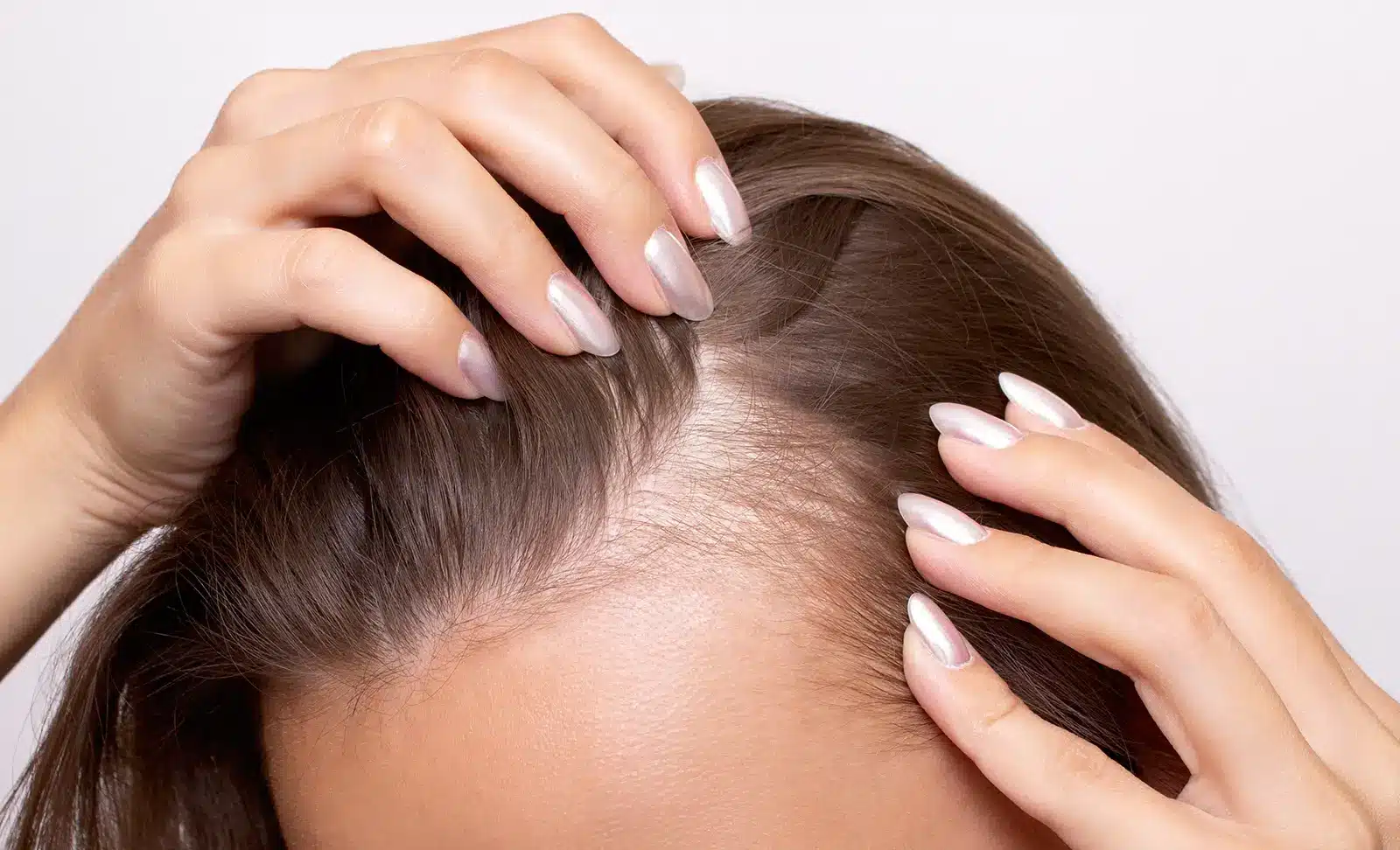Woman with hair loss at the temples