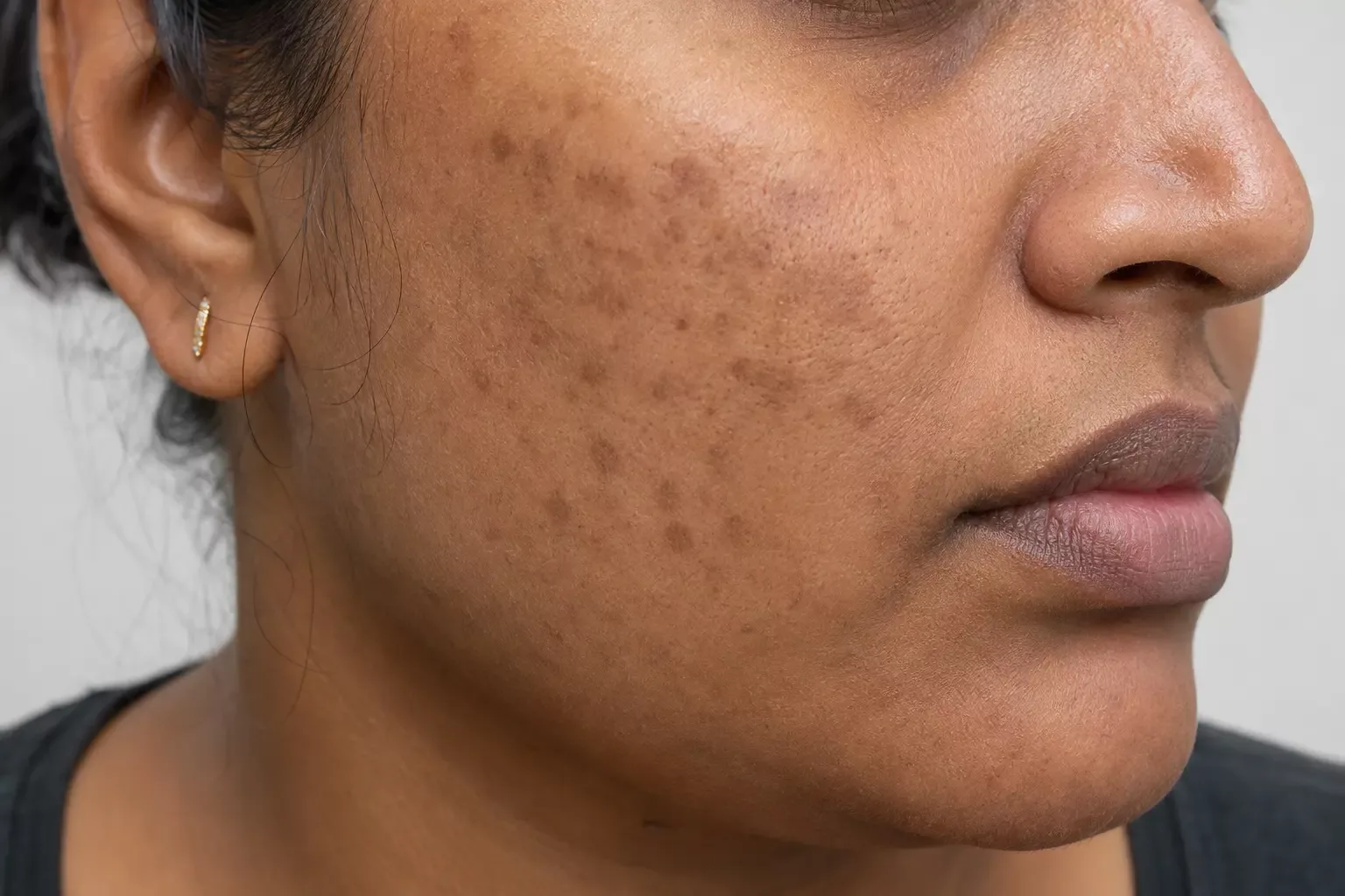 Acne marks and acne scars on the face