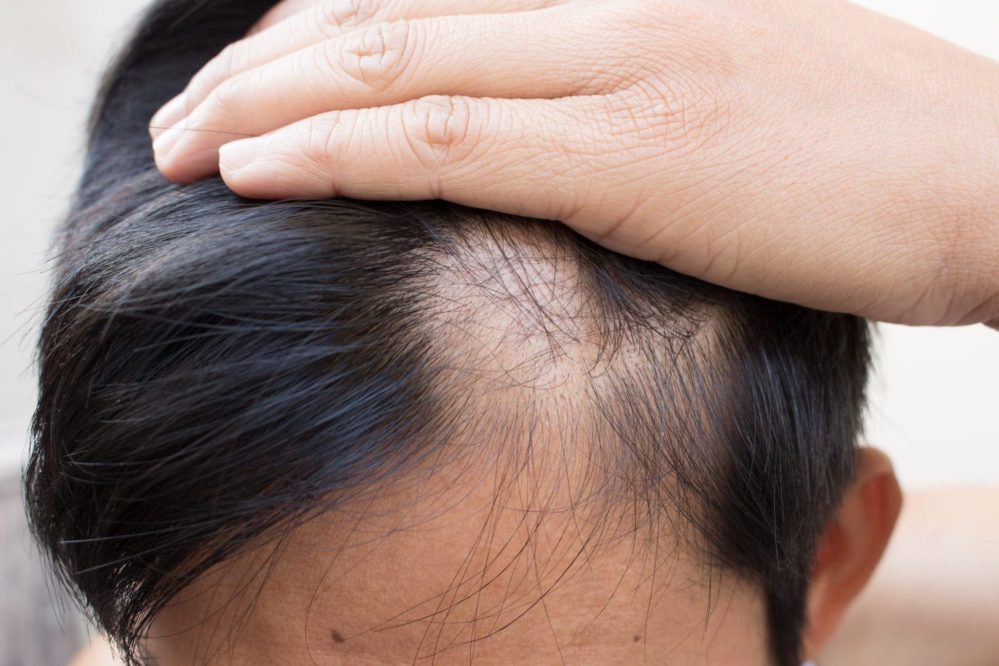 Bald patches on the scalp from autoimmune and other scalp conditions