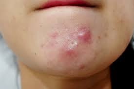 Deep and painful acne