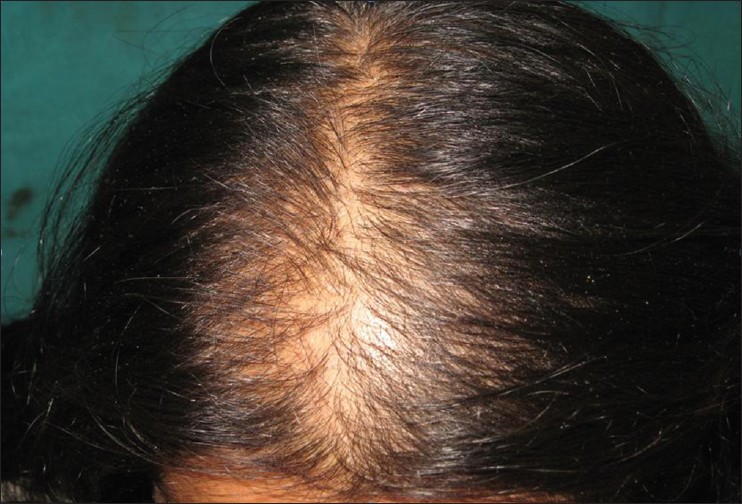 Long-term hair loss management