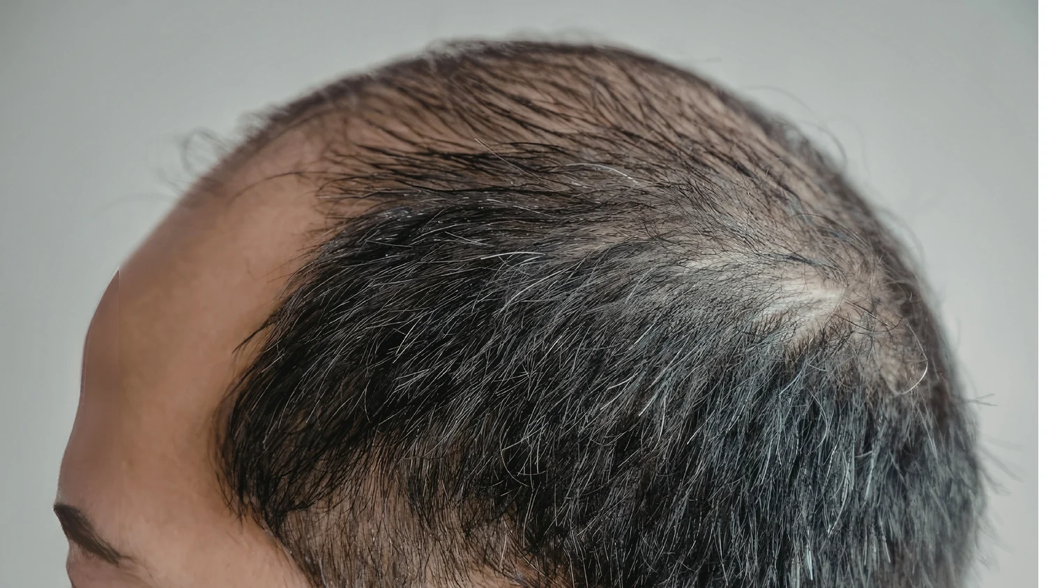 Types of hair loss assessed by a dermatologist