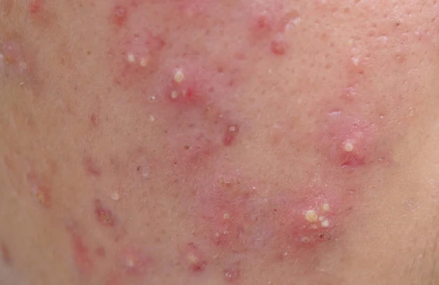Hormonal acne around the chin and jawline