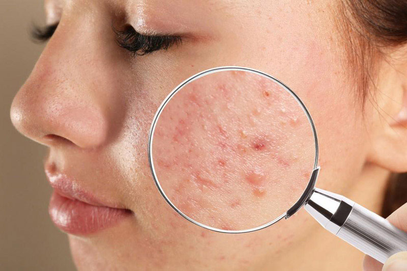 Inflamed red pimples (inflammatory acne)