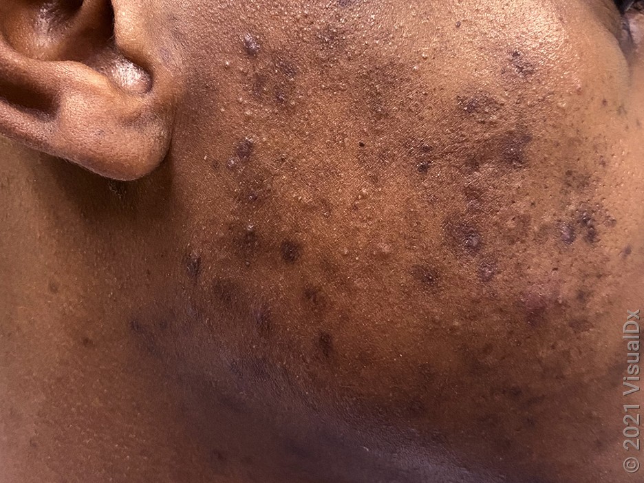 Mixed Scarring acne scar example