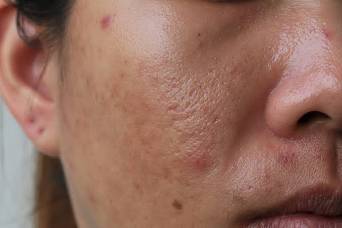 Oily and congested skin prone to acne