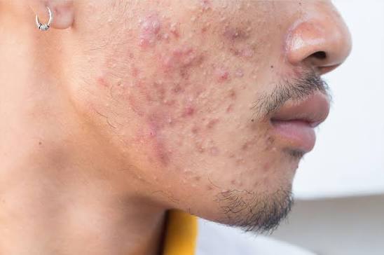 Recurring pimples on facial skin
