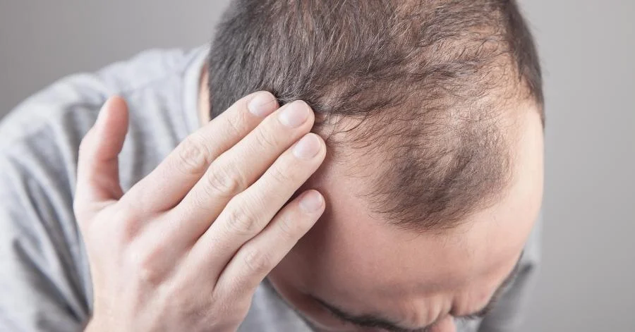 Visible hair thinning on the scalp caused by genetic pattern hair loss